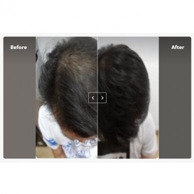 INDIBA® HairWave hair growth promoting apparatus 2